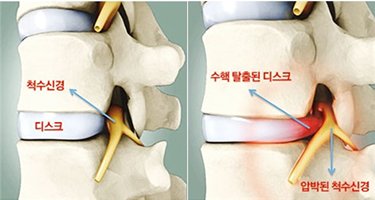 허리디스크