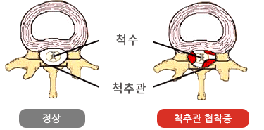 요척추협착증 증상