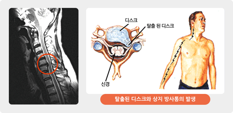 경추디스크 증상