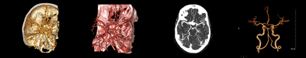 뇌 CT 및 뇌 CT 혈관 조영술