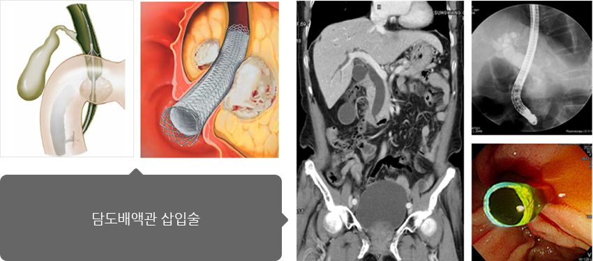 담도배액관 삽입술