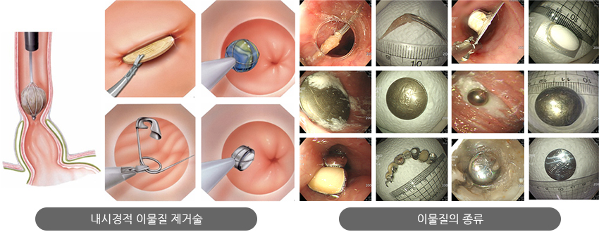 내시경적 이물질 제거술