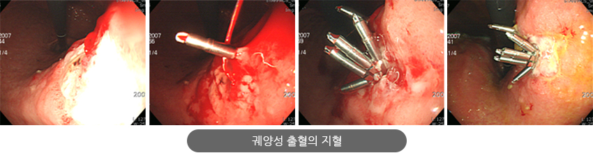 궤양성 출혈의 지혈