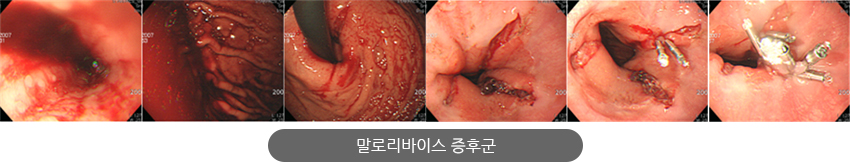 말로리바이스 증후군