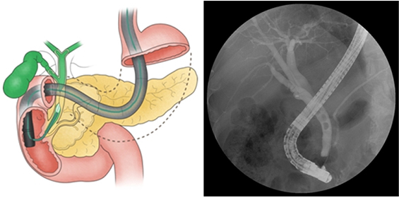 역행성 췌담관 조영술