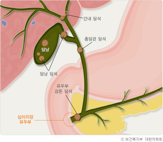 해부학적 위치에 따른 담석의 종류