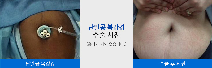 단일공 복강경 수술 후 사진