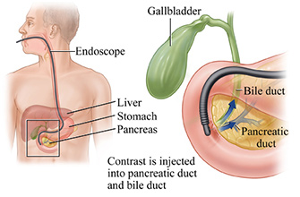 ERCP