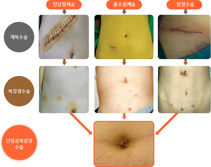단일공복강경 수술