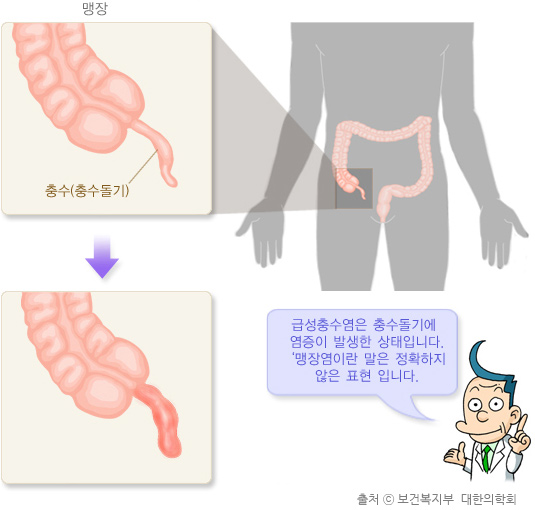 급성충수염 개념