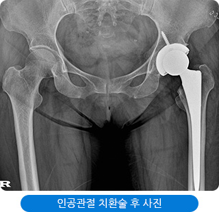 인공관절 치환술 후 사진