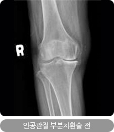 인공관절 부분치환술 전
