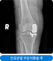 인공관절 부분치환술 후