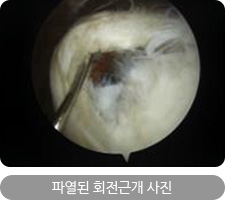 파열된 회전근개 사진