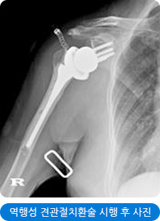 역행성 견관절치환술 시행 후 사진