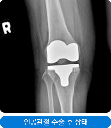 인공관절 수술 후 상태