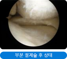 부분 절제술 후 상태