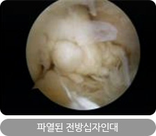 파열된 전방십자인대