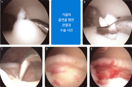 거골의 골연골 병변 관절경 수술 사진