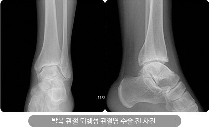 발목 관절 퇴행성 관절염 수술 전 사진