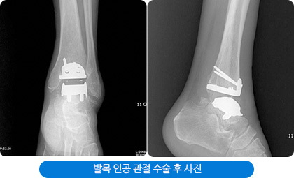 발목 인공 관절 수술 후 사진
