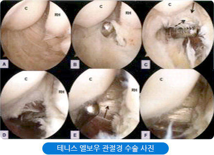 테니스 엘보우 관절경 수술 사진