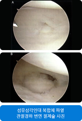 섬유삼각인대 복합체 파열 관절경하 변연 절제술 사진