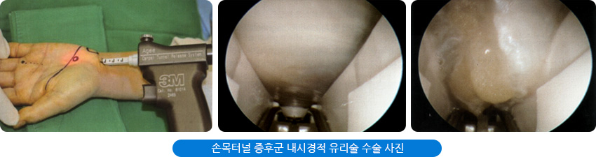 손목터널 증후군 내시경적 유리술 수술 사진