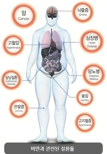 비만과 관련된 질환들