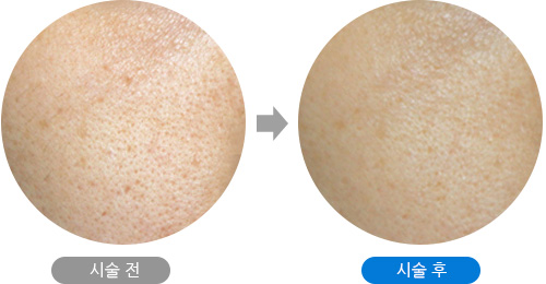TCA 필링 전후 TCA 필링 전후