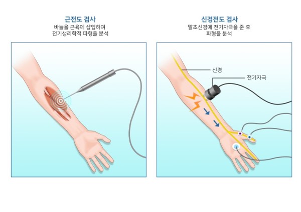 근전도검사_600